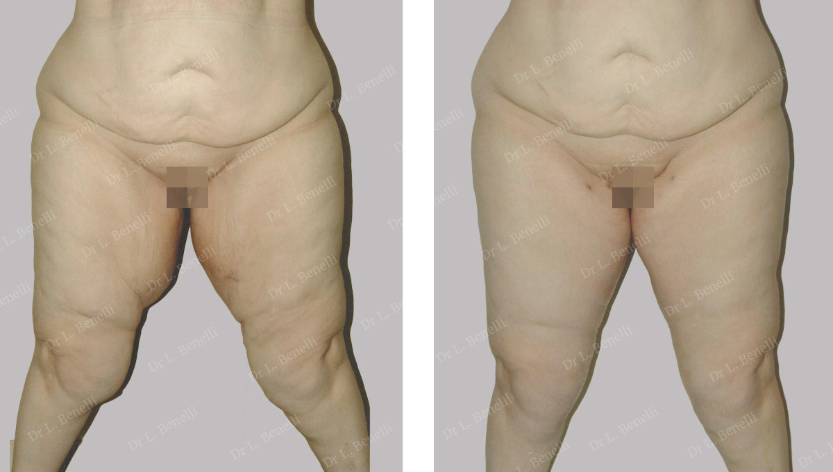 Thigh lift by Doctor Louis Benelli plastic surgeon in Paris