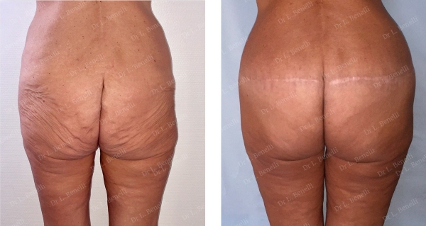 Lifting de cuisses avec cicatrice inguinale et bodylift postérieur réalisé par le Dr Louis Benelli chirurgien esthétique