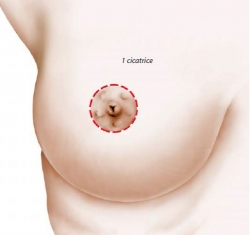 A scar only around the areola, using the Round Block technique