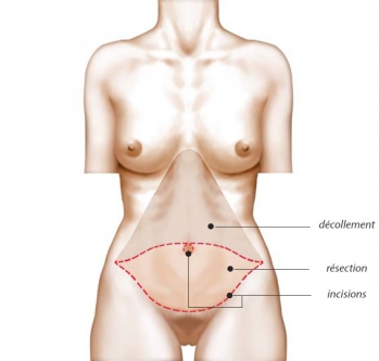 Abdominoplasty operating diagram