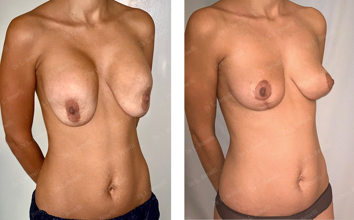 Ablation de prothèses mammaires réalisée par le Dr Benelli chirurgien plasticien