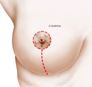 Areola reduction operating diagram