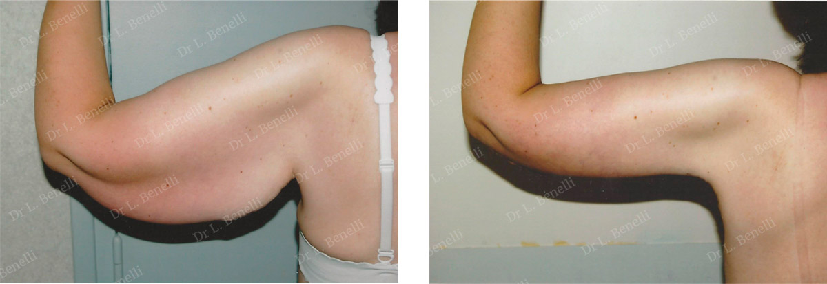 Arm lift performed by Dr. Louis Benelli, cosmetic surgeon
