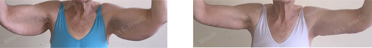 Arm lift performed by Dr. Louis Benelli plastic surgeon