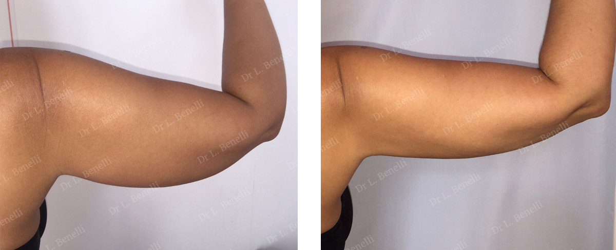 Before / after photo of arm liposuction by Dr Benelli