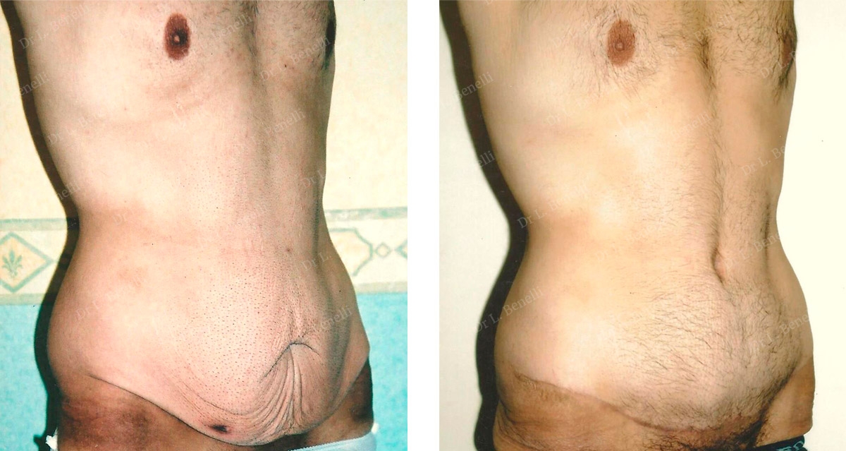 Before after photo of male tummy tuck by Dr. Benelli plastic surgeon
