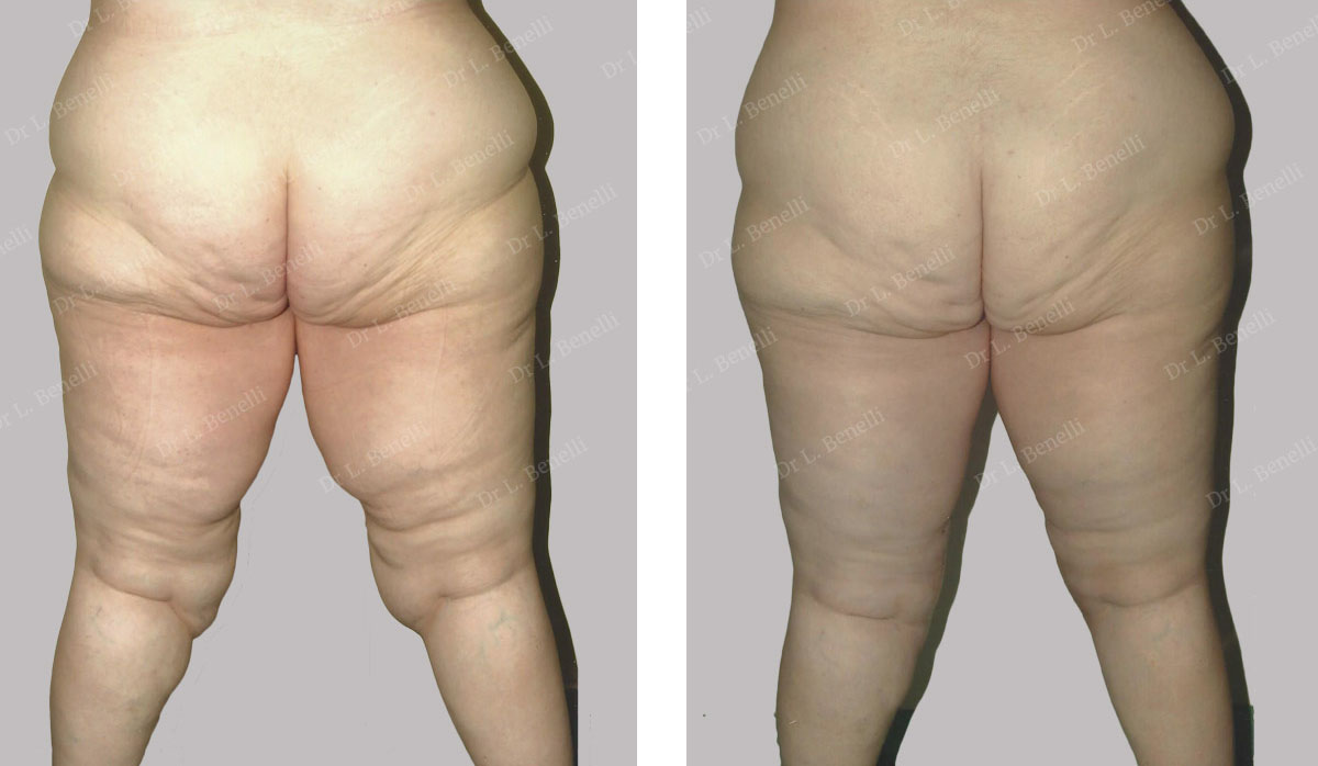 Before / after photo of thigh lift by Dr Benelli
