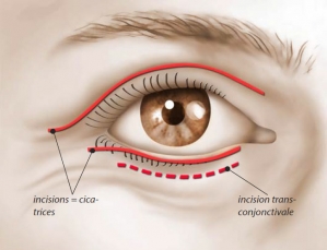 Blepharoplasty operating diagram