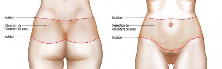 Body lift operating diagram