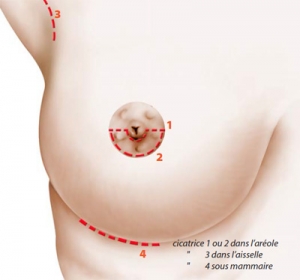 Breast augmentation procedure diagram