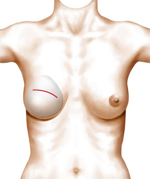 Breast reconstruction operating diagram using a prosthesis