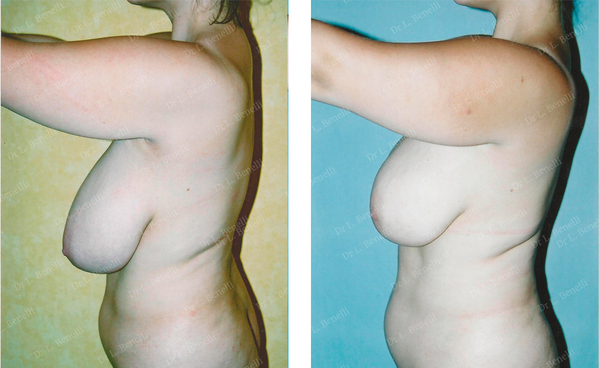 Breast reduction photo taken by Dr Louis Benelli, plastic surgeon