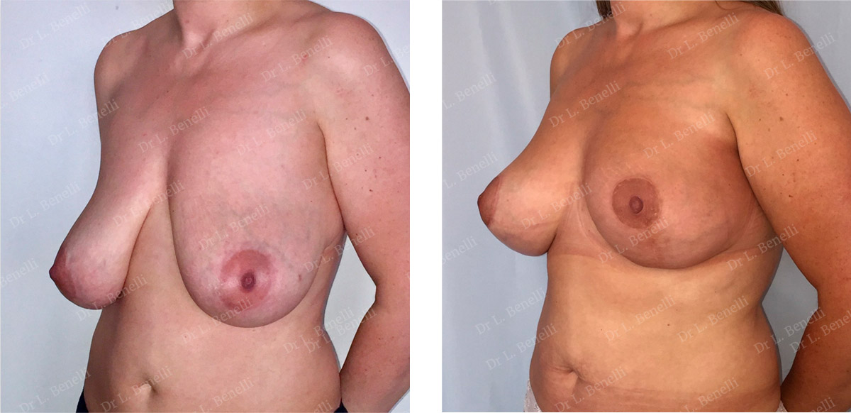 Breast reduction photo taken by Dr. Louis Benelli, plastic surgeon