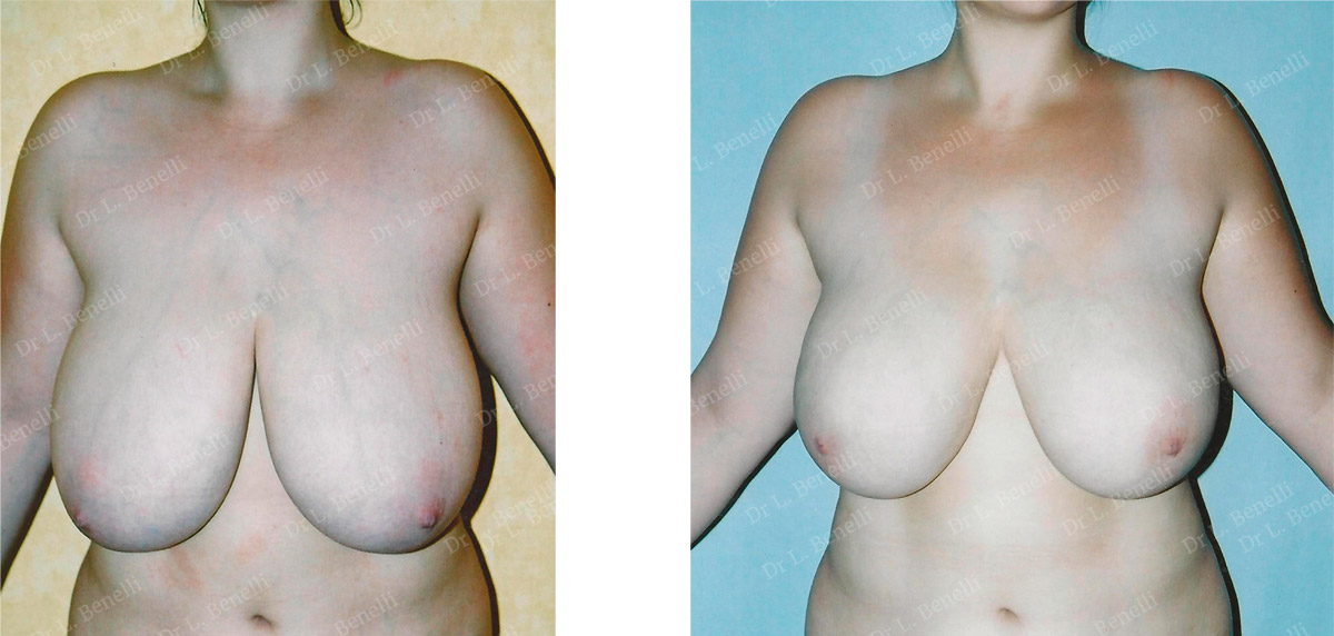 Breast reduction photo taken by Dr Louis Benelli, plastic surgeon