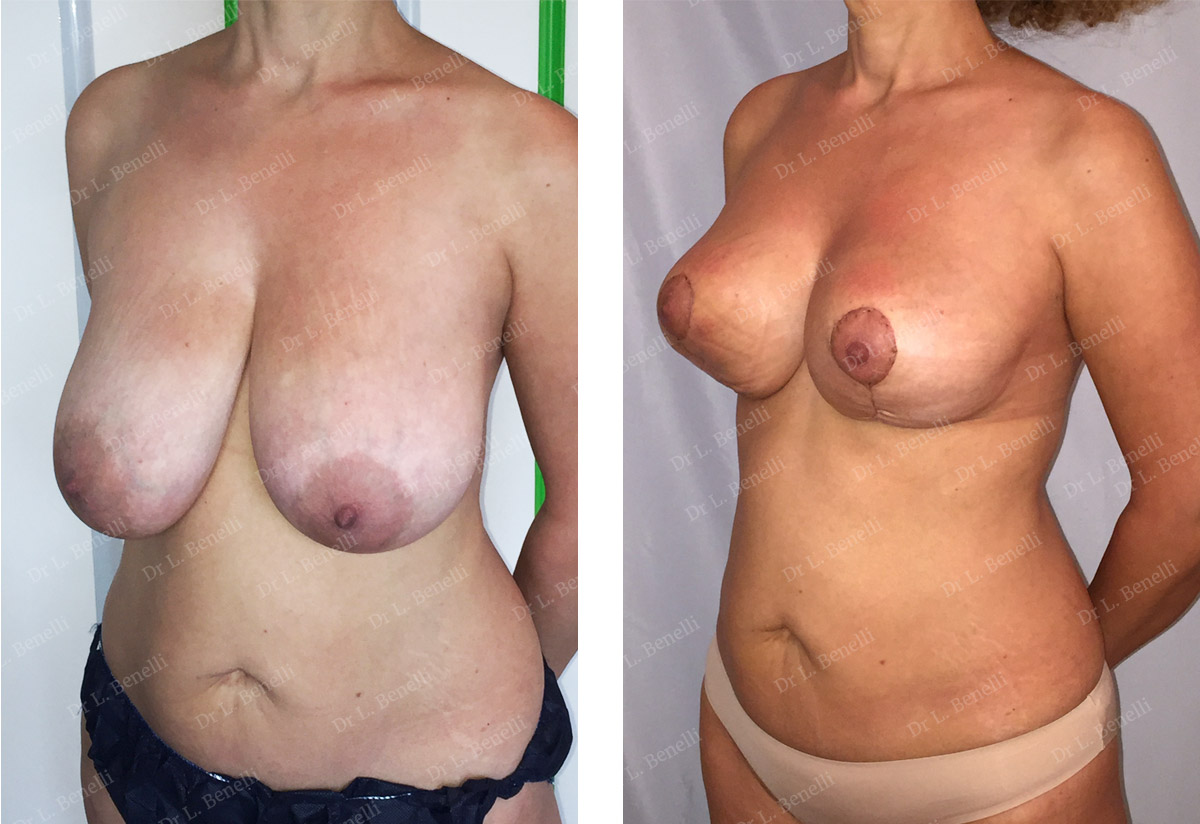 Breast reduction photo taken by Dr Louis Benelli, plastic surgeon