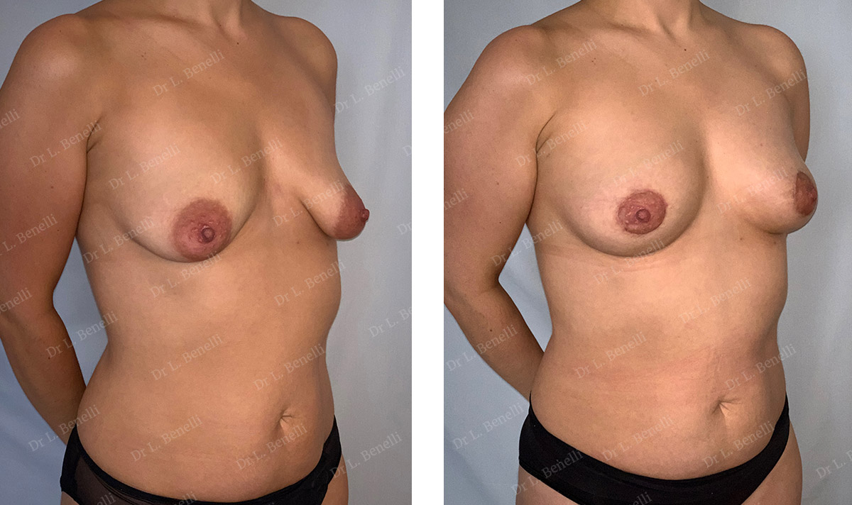 Correction de seins tubéreux par technique Round Block réalisée par le Dr Benelli