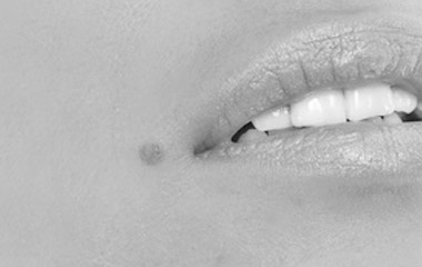 Dermatological surgery