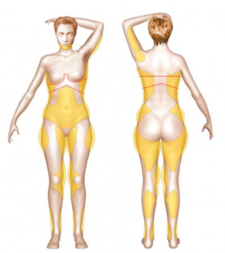 Diagram of areas treated with liposuction during an upper body lift procedure