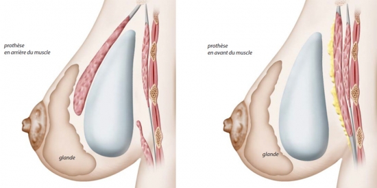 Diagram of the breast prostheses positioned in front of, or behind, the muscle 