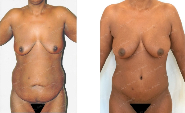 Photo de plastie abdominale réalisée par le Dr Louis Benelli chirurgien esthétique