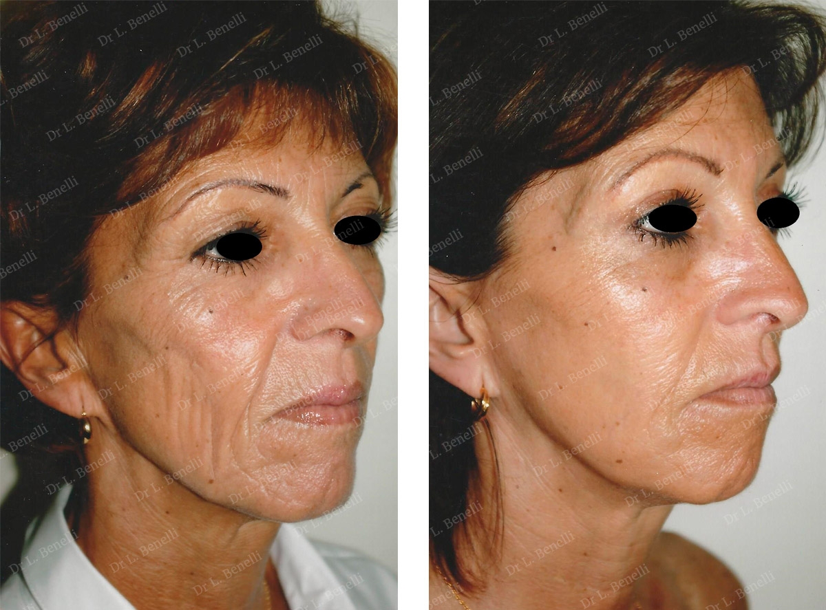 Facelift photo taken by Dr Louis Benelli, plastic surgeon