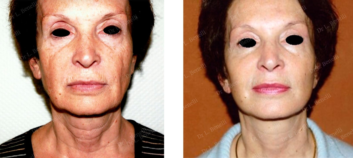 Facelift photo taken by Dr Louis Benelli, plastic surgeon