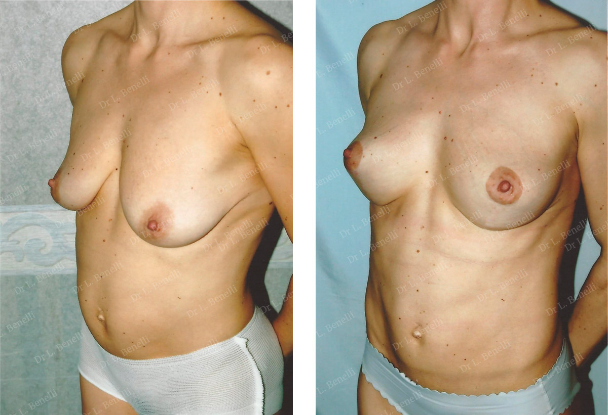 Lifting des seins réalisé par le Dr Benelli chirurgien esthétique