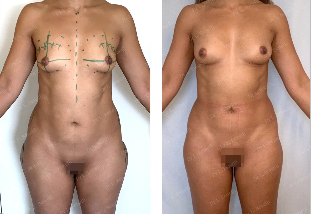 Lipofilling des seins réalisés par le Dr Benelli chirurgien plasticien