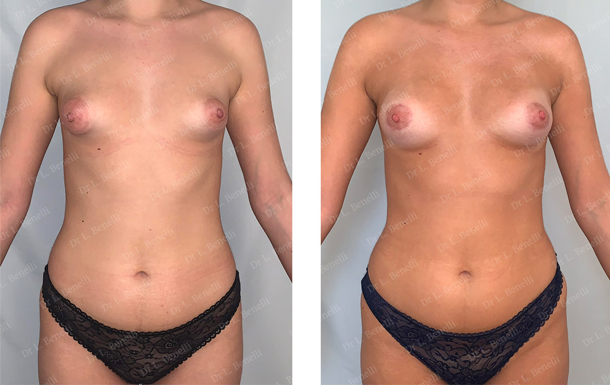 Photo avant / après d'augmentation mammaire par lipofilling