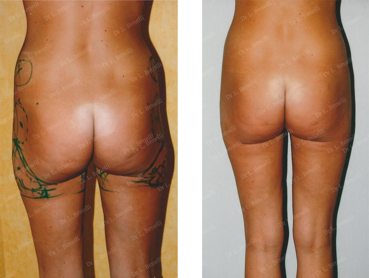 Liposuction performed by Dr Louis Benelli, plastic surgeon