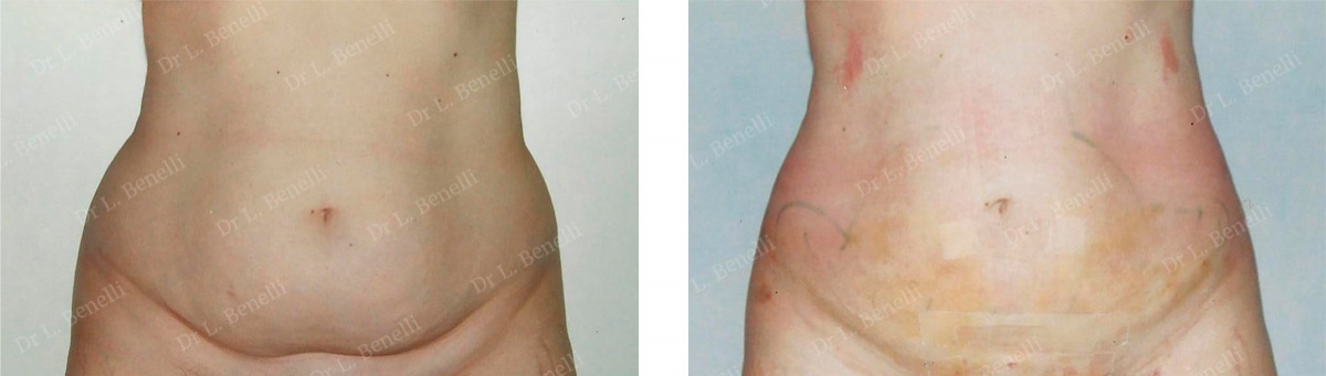 Lipoaspiration réalisée par le Dr Louis Benelli chirurgien esthétique