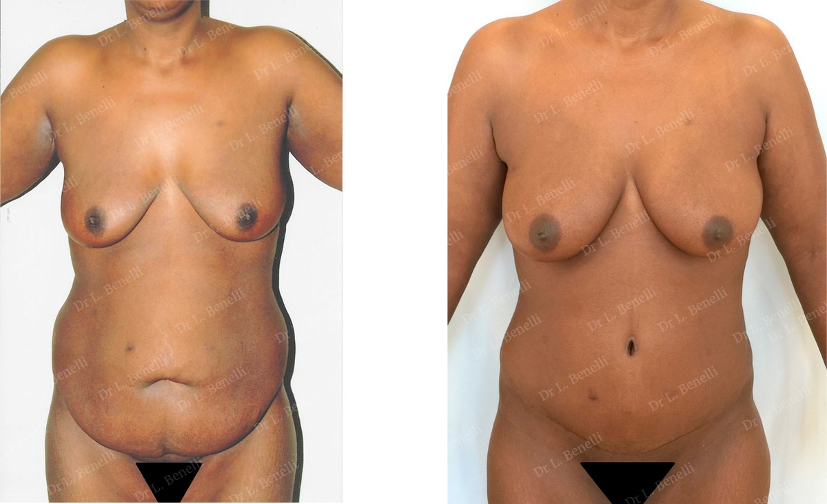 Photo de plastie abdominale réalisée par le Dr Louis Benelli chirurgien esthétique