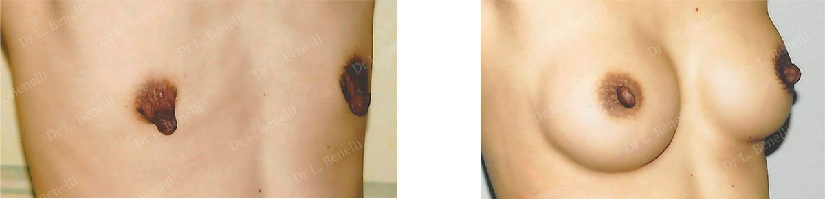 Photo de réduction de mamelon par le Dr Benelli chirurgien esthétique
