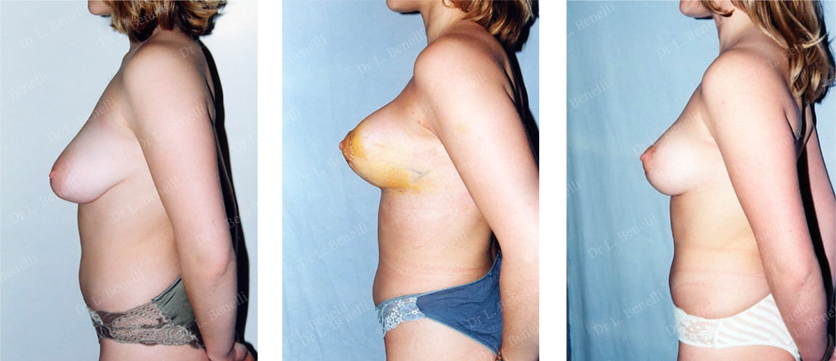 Photo de réduction mammaire réalisée par le Dr Louis Benelli chirurgien esthétique