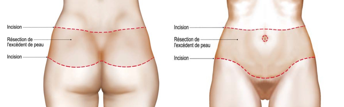 Schéma opératoire bodylift
