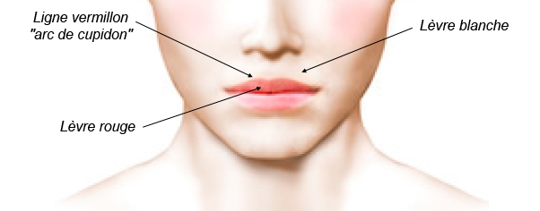 Schéma opératoire de la chirurgie des lèvres
