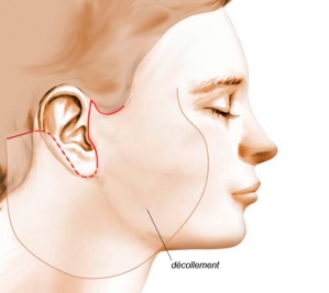 Schéma opératoire de lifting cervico-facial