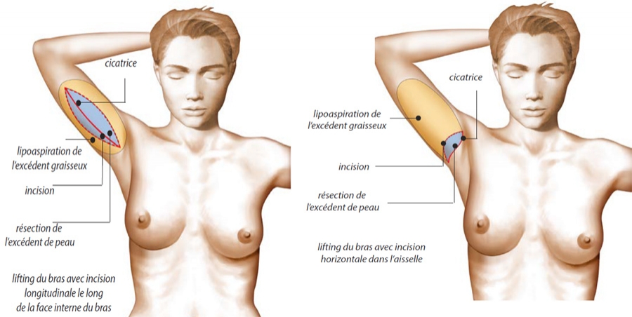 Schéma opératoire de lifting des bras