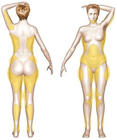 Schéma opératoire des zones de liposuccion