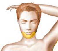 Schéma opératoire intervention lipomodelage du visage en chirurgie esthétique