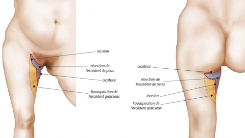 Schéma opératoire lifting des cuisses