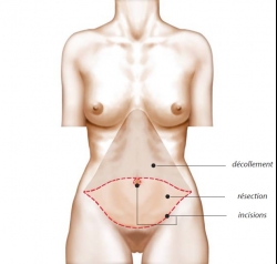 Schéma opératoire plastie abdominale