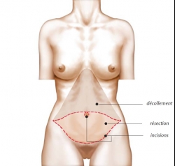 Schéma opératoire plastie abdominale