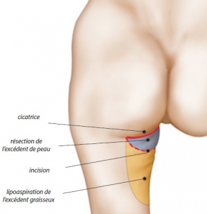 Operating diagram of a thigh lift