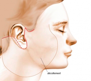 Operating diagram of cervico-facial lifting