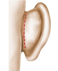 Otoplasty operating diagram