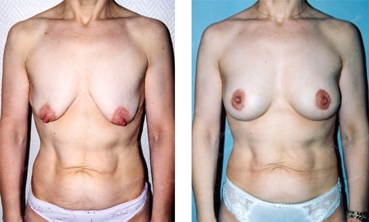 Photo augmentation mammaire réalisée par le Dr Louis Benelli chirurgien esthétique