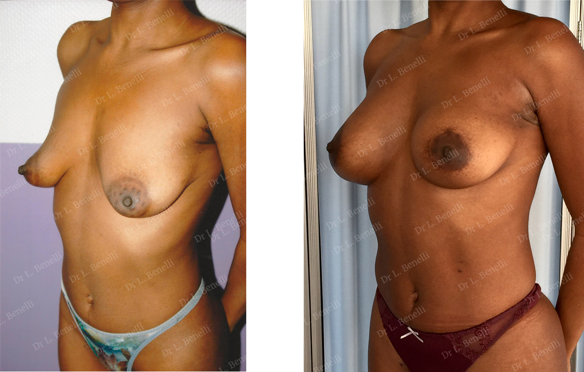 Photo avant après de lifting des seins réalisé par le Dr Benelli chirurgien esthétique