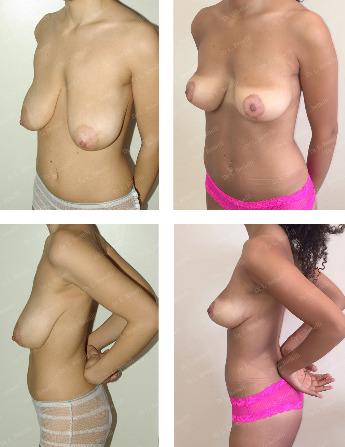 Photo avant après de lifting des seins réalisé par le Dr Benelli chirurgien esthétique
