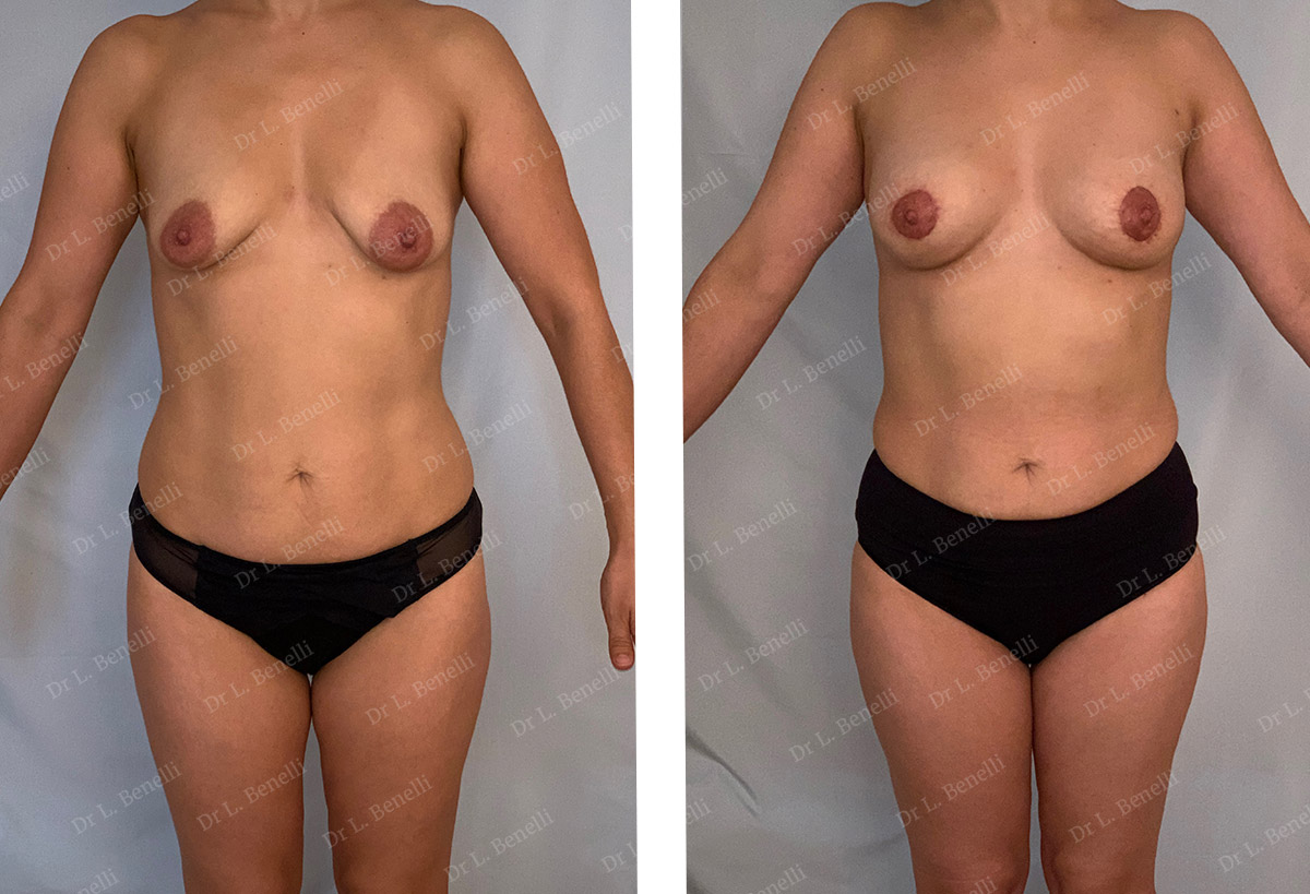 Photo avant après de lipofilling des seins réalisé par le Dr Benelli chirurgien plasticien